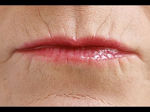 lip lines vertical wrinkles around mouth filler volbella lips introducing perioral rid exercises lipstick smokers dr line musely yoga